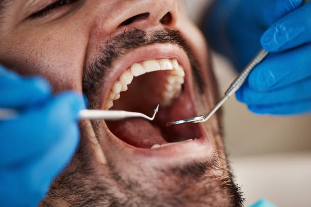 Best Emergency Tooth Extraction in Detroit Beach, MI